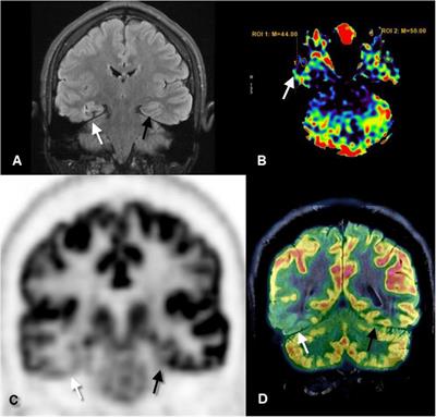 Advances in Brain Imaging Techniques for Patients With Intractable Epilepsy